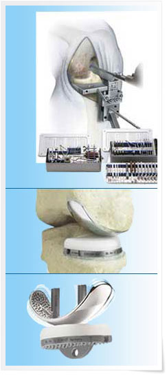 Миниинвазивная техника имплантации одномыщелковых скользящих протезов Endo-Model® MITUS®