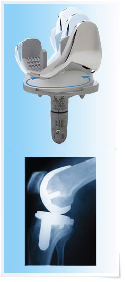 Система протезирования коленного сустава GEMINI™ MKII