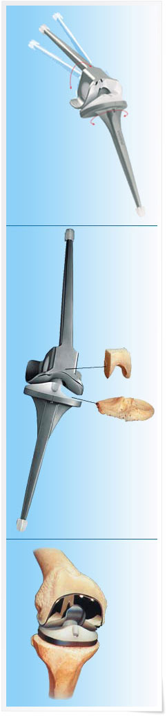 Ротационная система тотального протезирования коленного сустава LINK® Endo-Model®