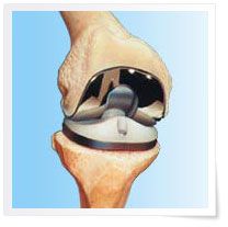 Rotational Total Knee System